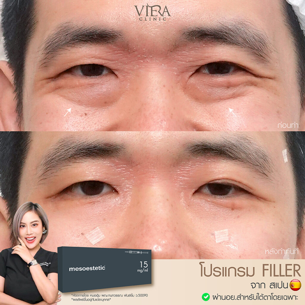 review filler