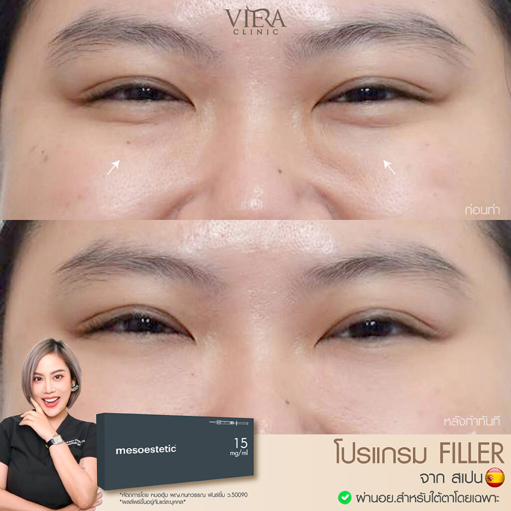 review filler