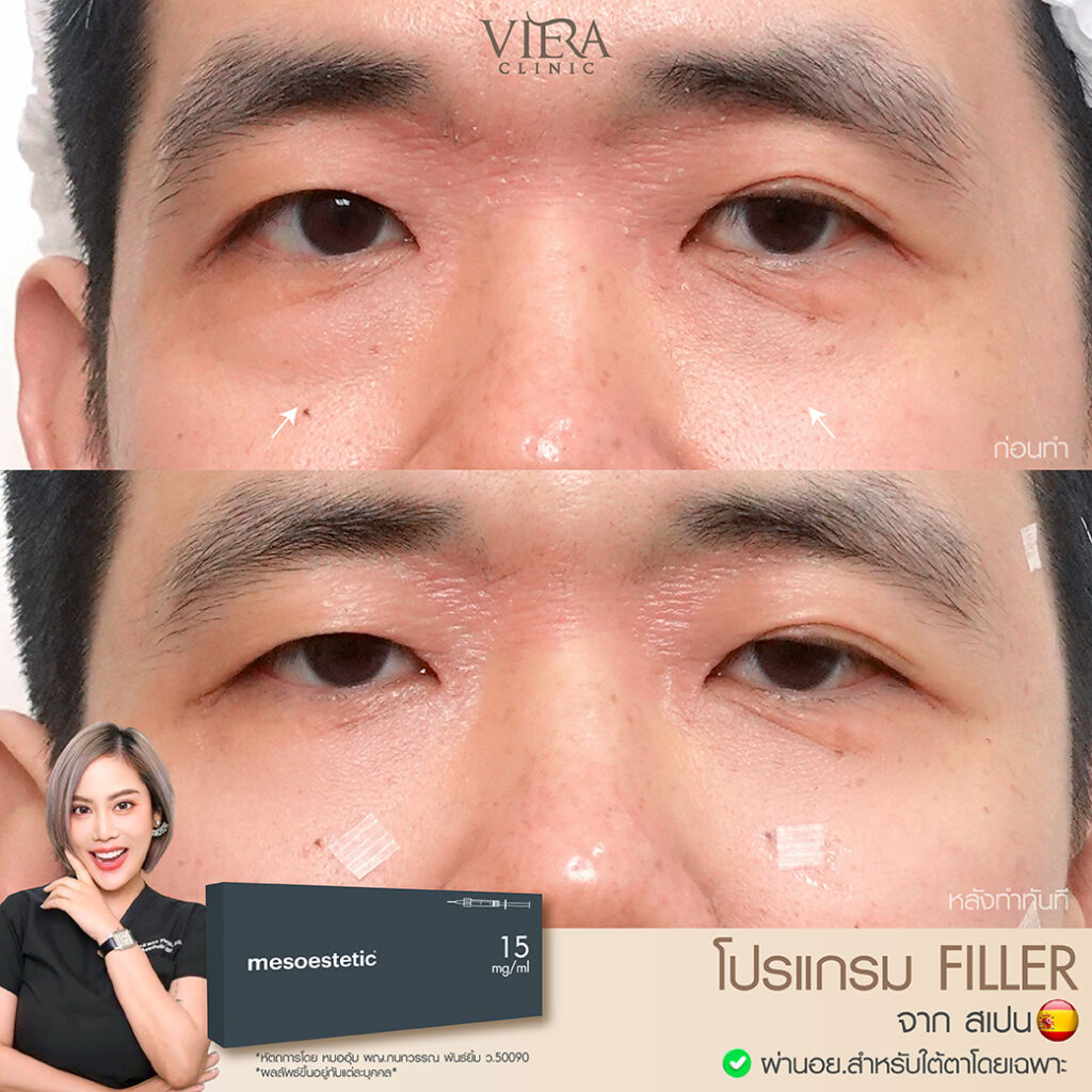 review filler
