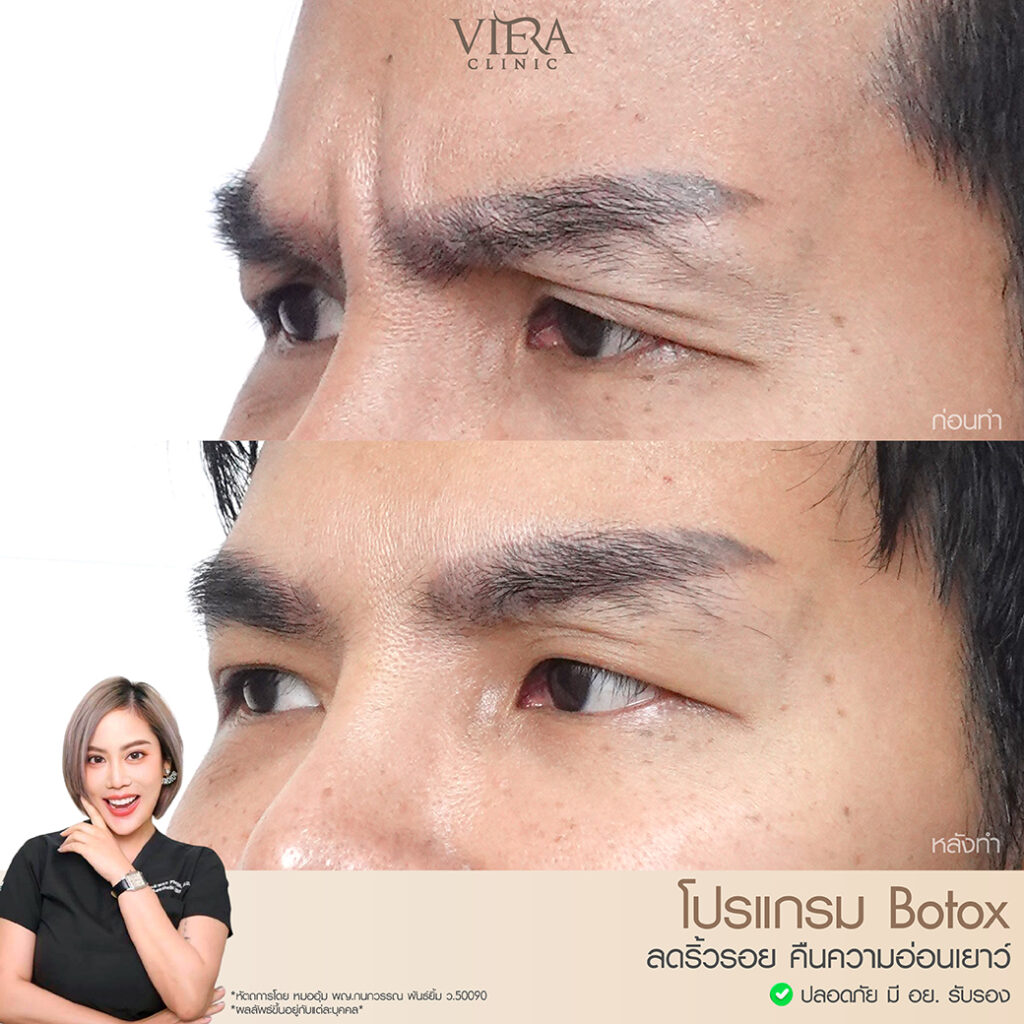 reviewbotox