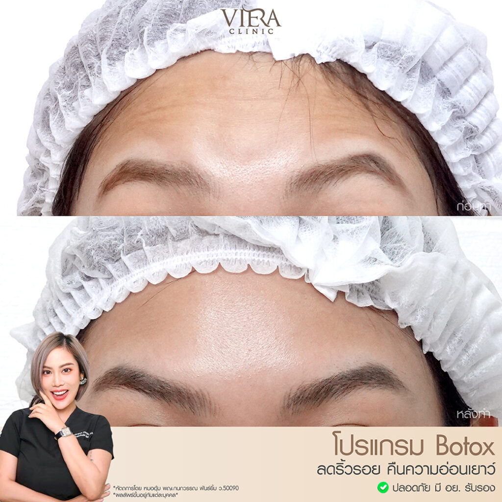 reviewbotox