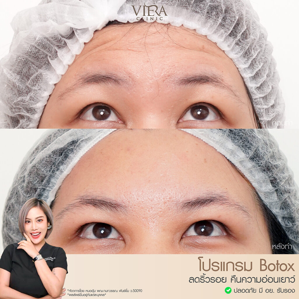 reviewbotox